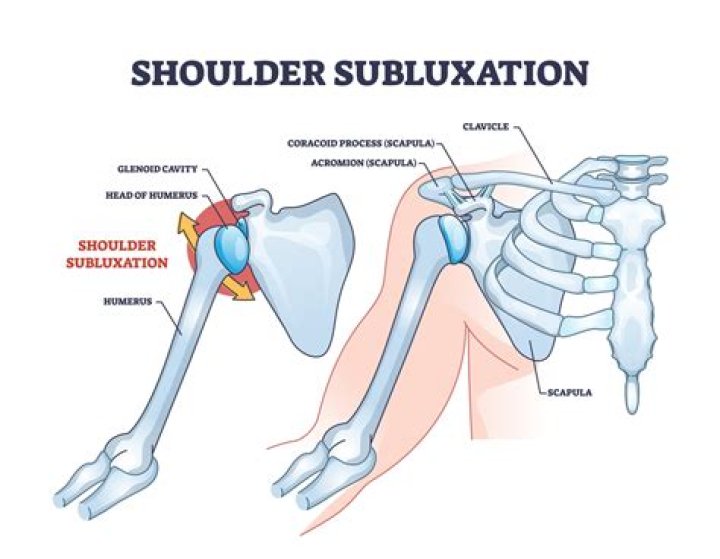 When was subluxation first used?