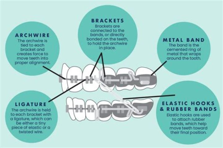 Where are braces worn?