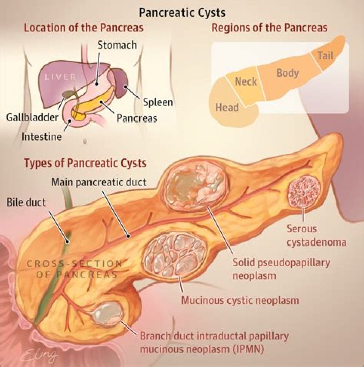 Where are pancreatic pseudocysts found?