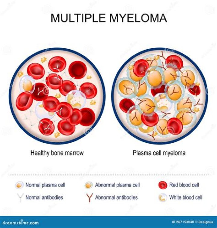Where can myeloma be found?