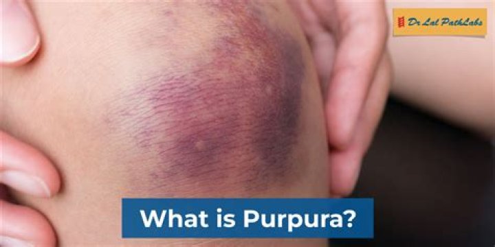 Where does purpura occur?