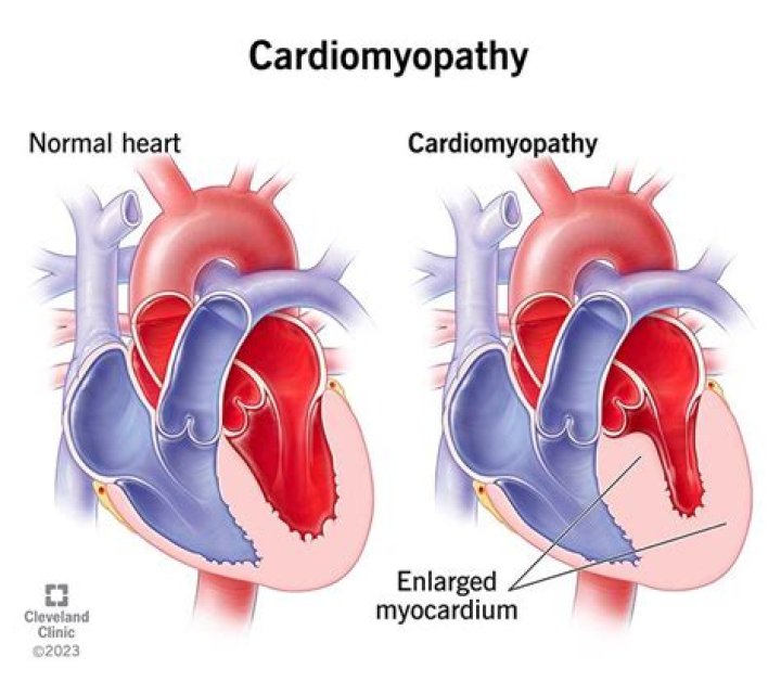 Where is cardiomyopathy located?
