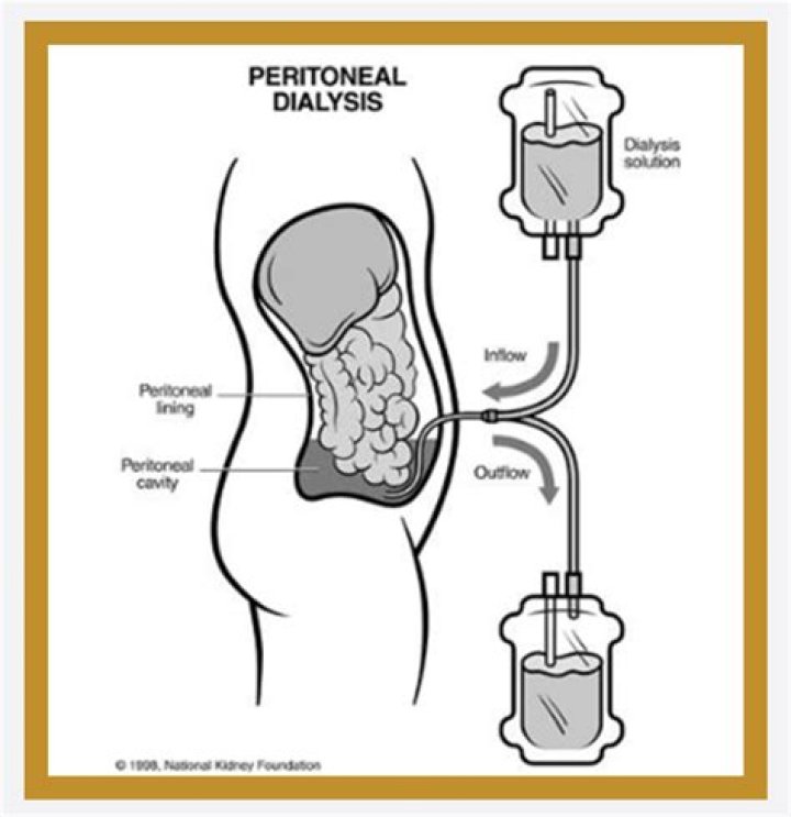 Where is peritoneal dialysis done?