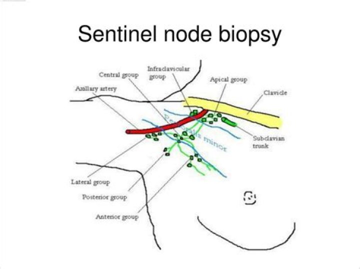 Where is sentinel lymph node?