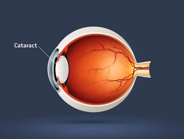 Where is the cataract located?