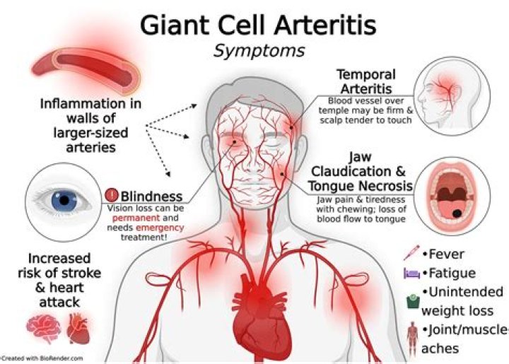 Where is the pain with temporal arteritis?