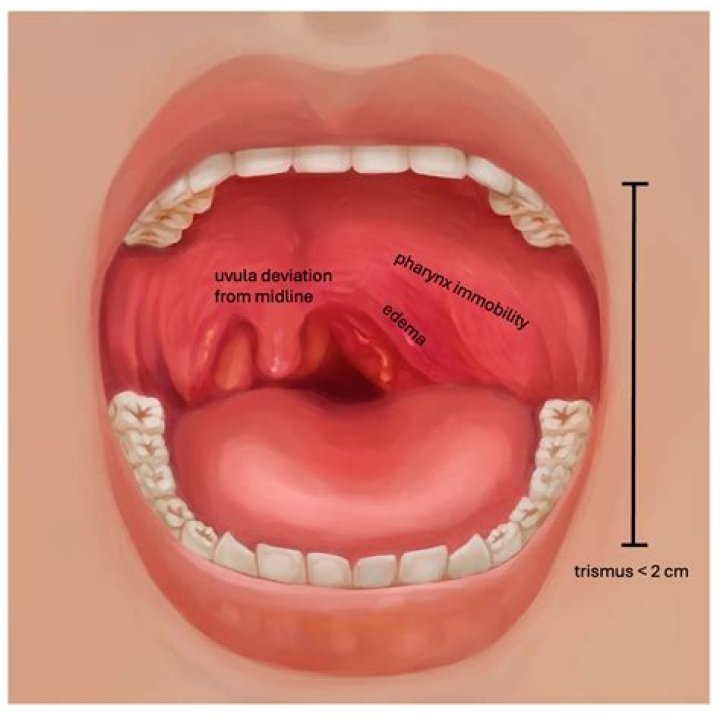 Where is the uvula vesicae?