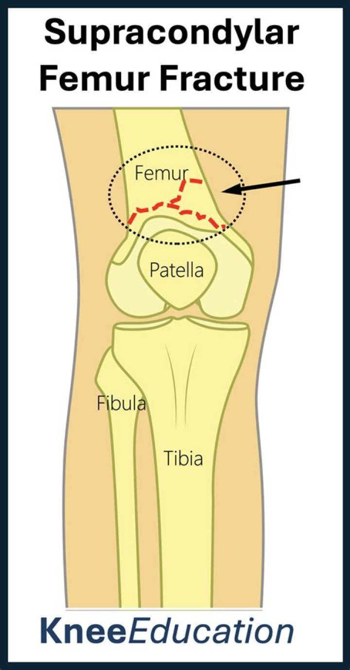 Where is transcondylar fracture?