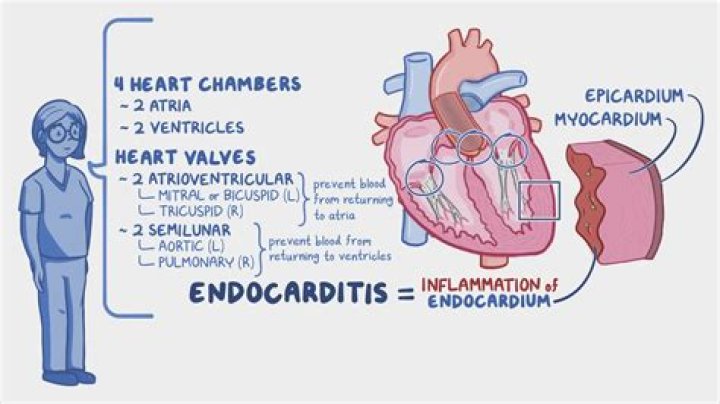 Which areas of the heart are affected by carditis?