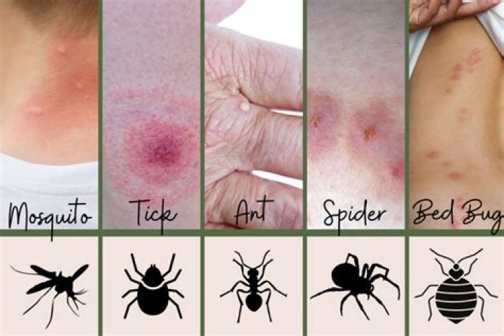 Which bug bite is the itchiest?