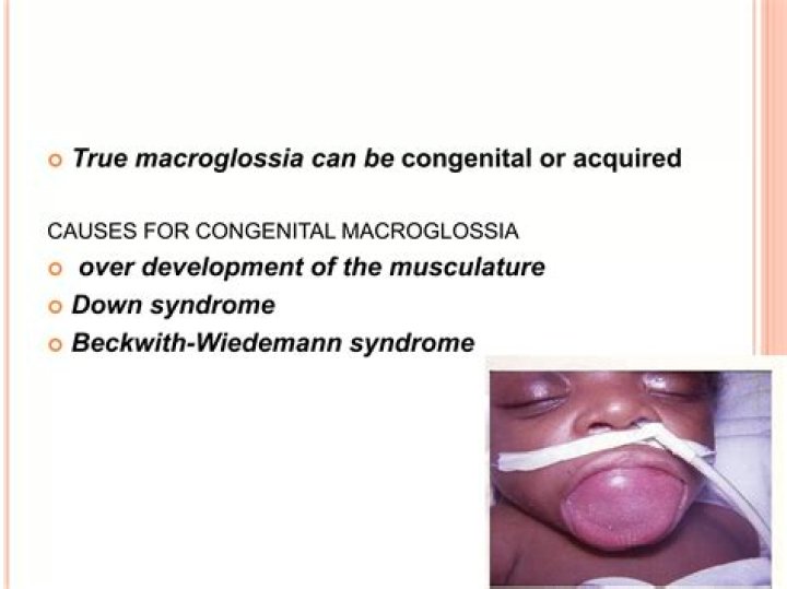 Which cause of macroglossia is developmental?