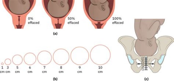 Which happens first effacement or dilation?