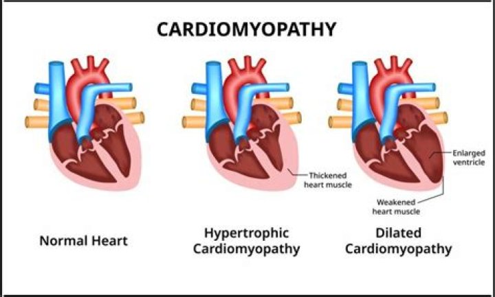 Which type of cardiomyopathy is associated with childbirth?