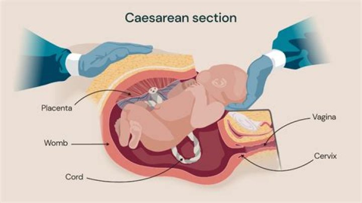 Who does c section?