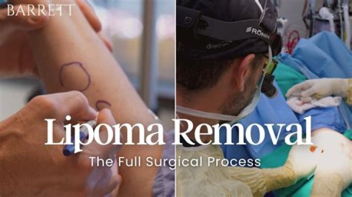 Who does lipoma removal?