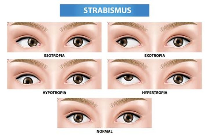 Who does strabismus affect?