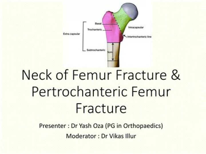 Who fracture neck of femur?