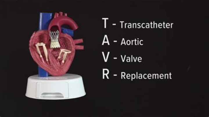 Who invented the tavr procedure?