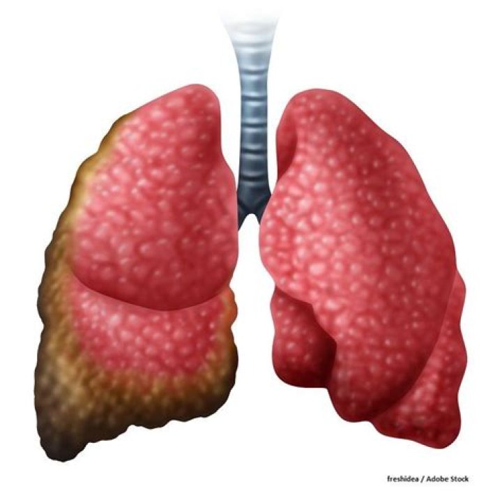 Who is the actor in the mesothelioma commercial?