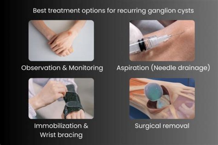 Who removes a ganglion cyst from the wrist?