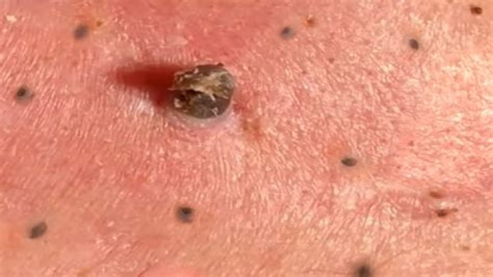 Who removes blackheads from back?