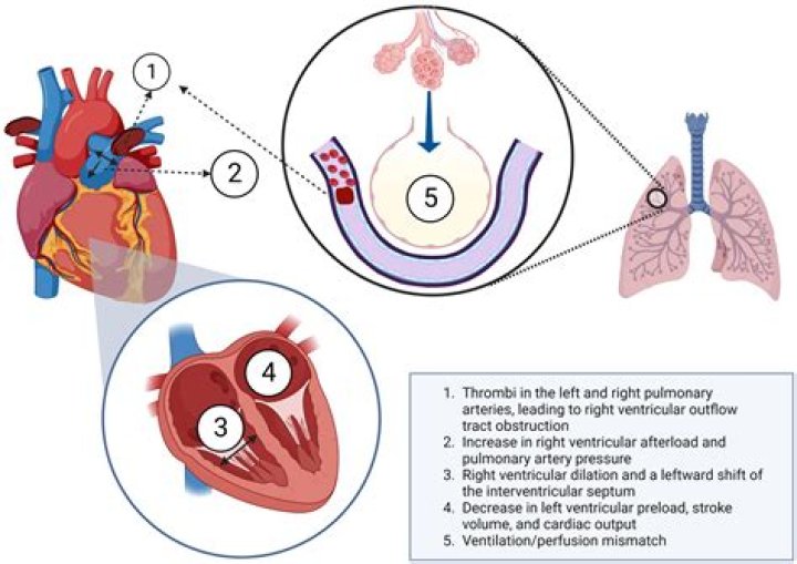 Whos at risk for pulmonary embolism?