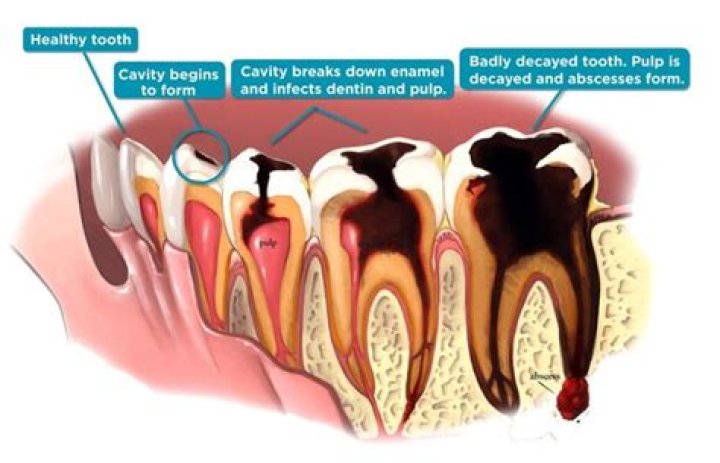 Why cavity smells bad?