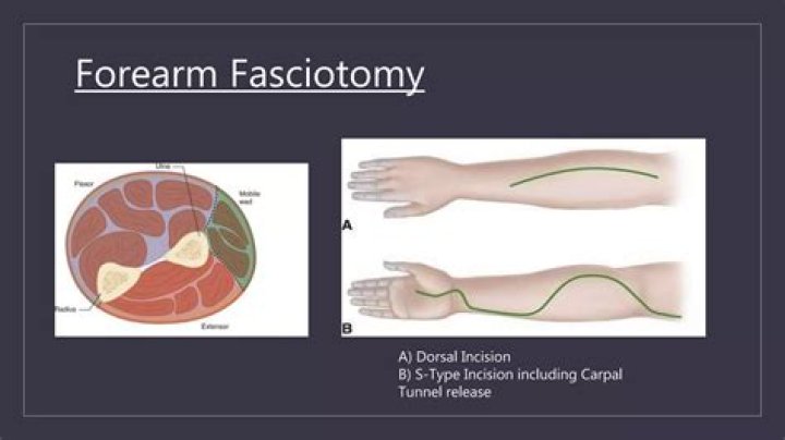 Why do a fasciotomy?
