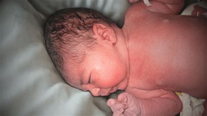 Why do babies get encephalocele?