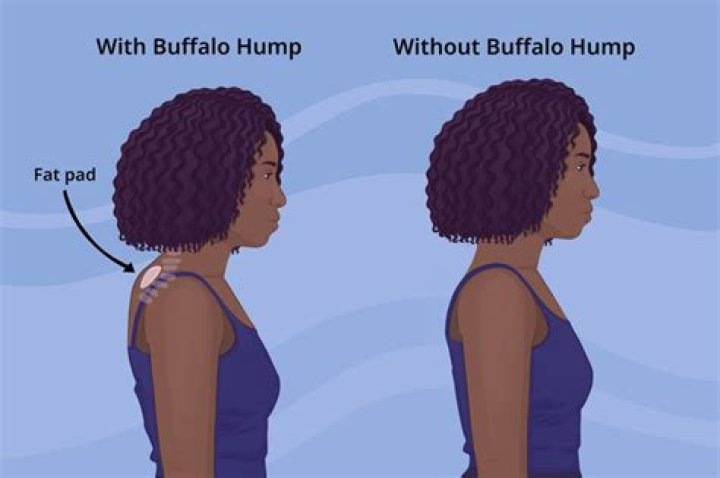 Why do buffaloes have humps?