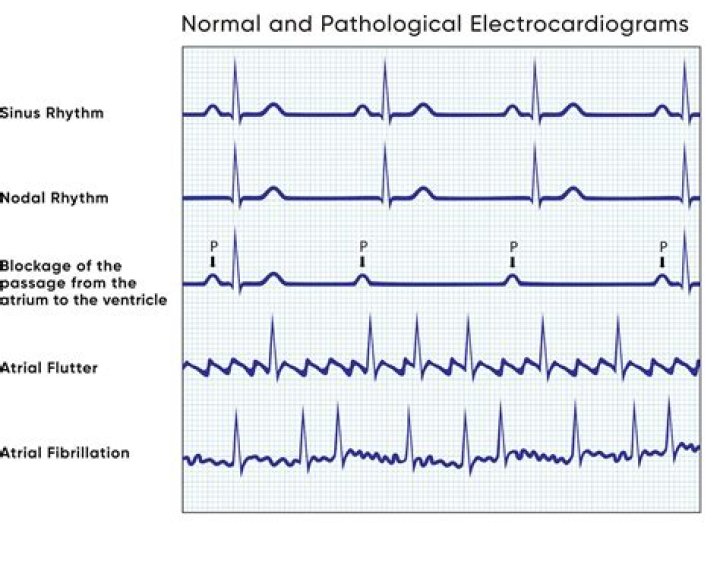 Why does extrasystole occur during relaxation?