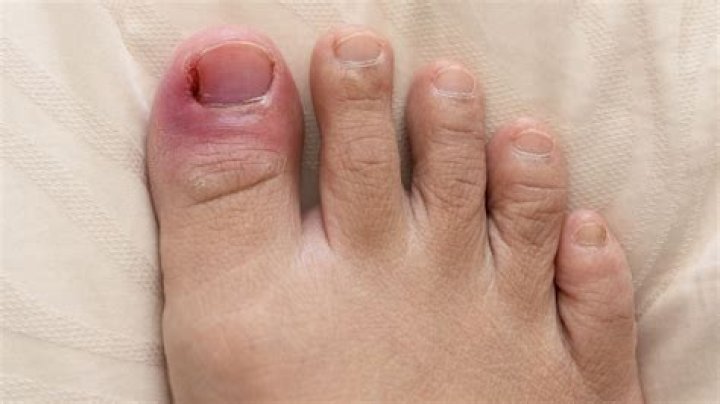 Why is my big toe cuticle swollen?