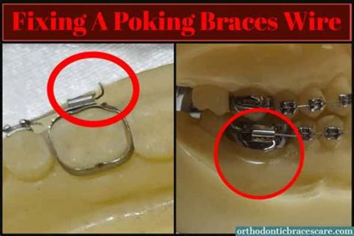 Why is my braces wire poking me?