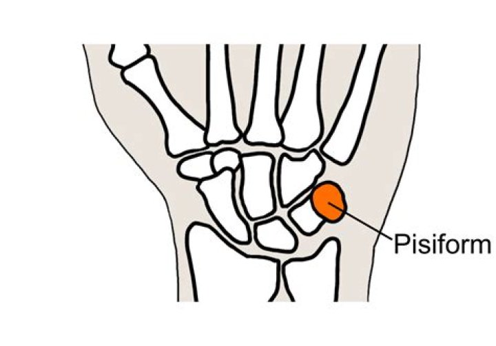 Why is my pisiform bone sore?
