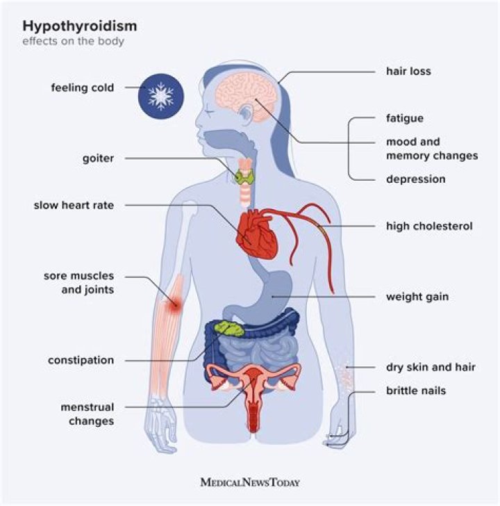 Why macroglossia in hypothyroidism?