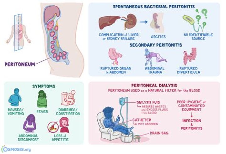 Why peritonitis is a very serious condition?