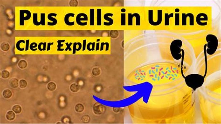 Why pus cells increase in urine?