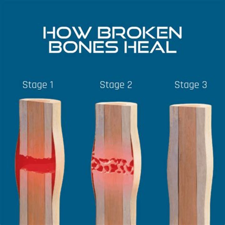 Will a broken bone make you tired?