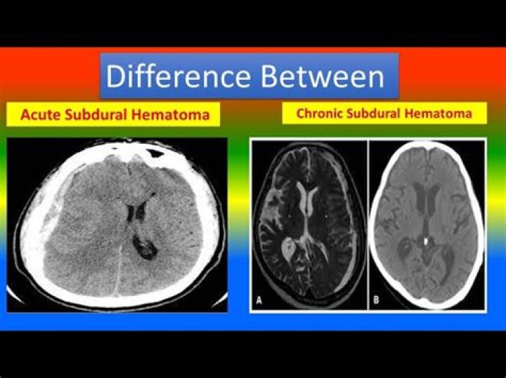 Will a ct scan show subdural hematoma?