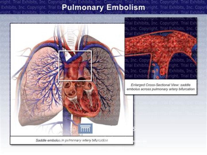 Will an ecg show a pulmonary embolism?