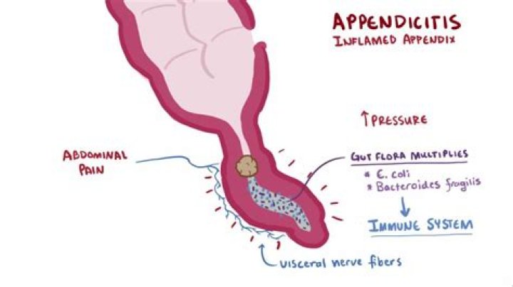 Will appendicitis go away?