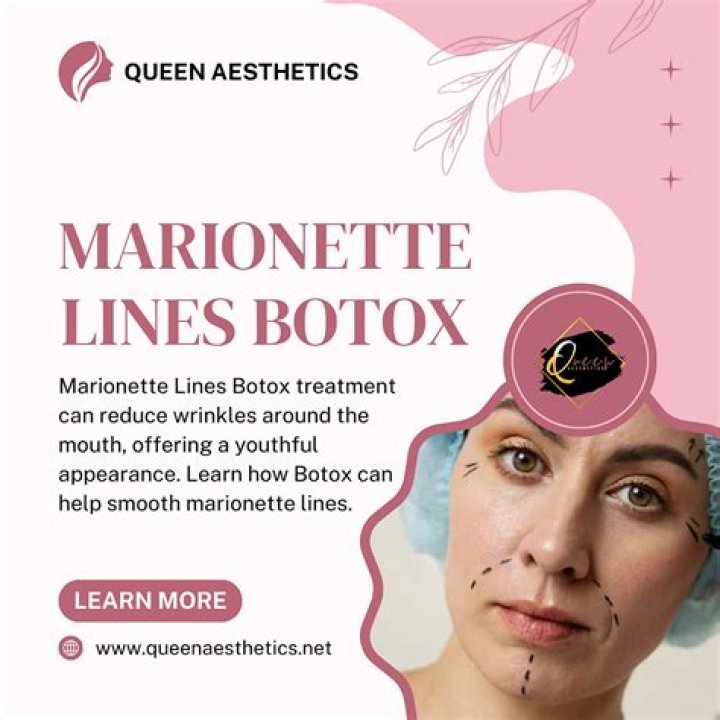 Will botox work on marionette lines?