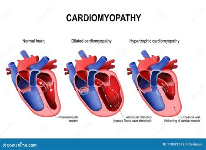 Will cardiomyopathy show up on an ecg?