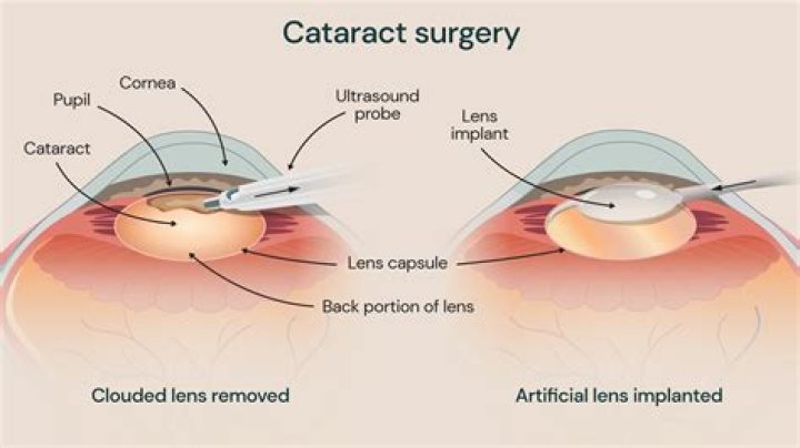 Will cataract surgery correct my vision?