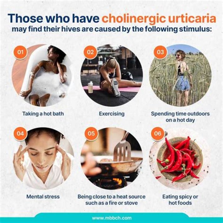 Will cholinergic urticaria ever go away?