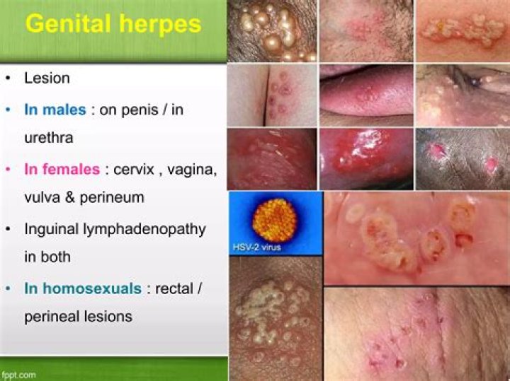 Will genital herpes go away?