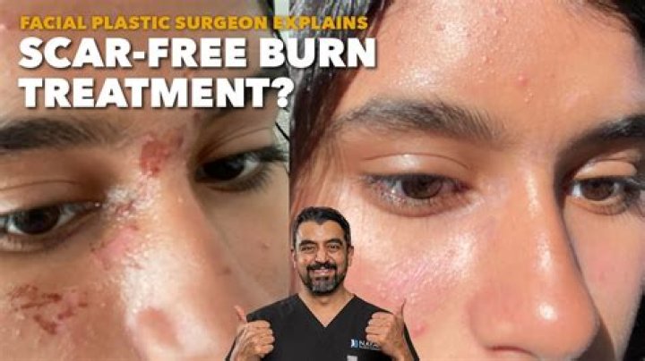 Will grease burn scar?