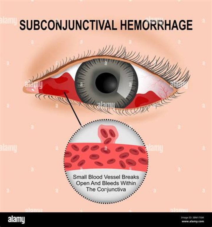 Will ice help subconjunctival hemorrhage?