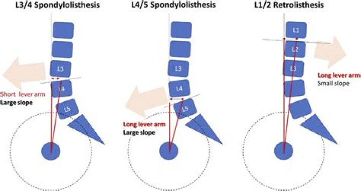 Will mri show spondylolisthesis?