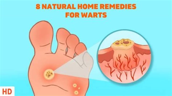 Will warts go away on their own?